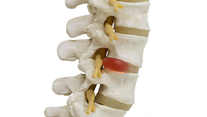 Spine with herniated disc