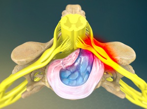 Herniated disc as a condition treatable with chiropractic care