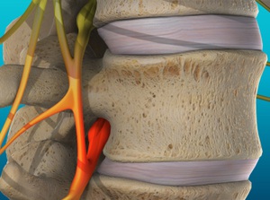 Education about vertebral subluxation and chiropractic care